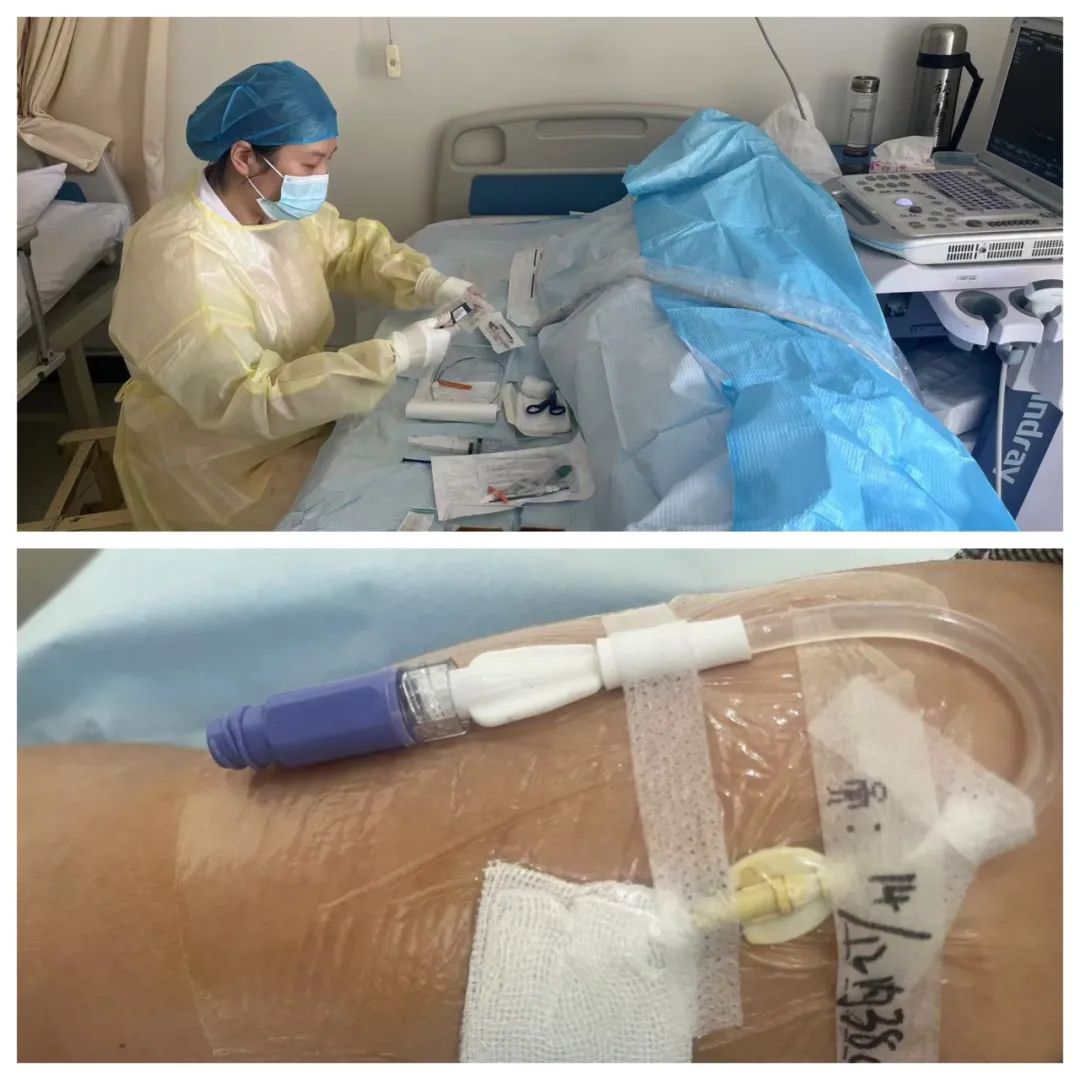 【专科护理】旌德县人民医院PICC置管护理—守护患者的生命线