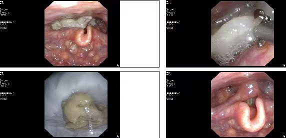 【“深喉”探物，镜到病除】旌德县人民医院耳鼻咽喉科巧取致命异物